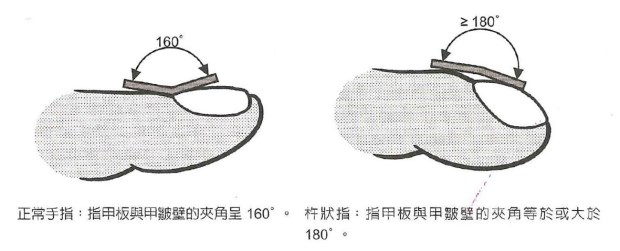 怎樣看出心臟有問題 從手指、舌頭眼神測試
