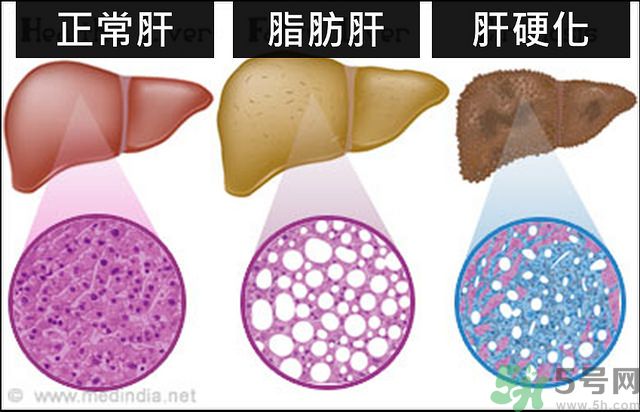 得了脂肪肝該怎么治？脂肪肝對人體危害有多大？
