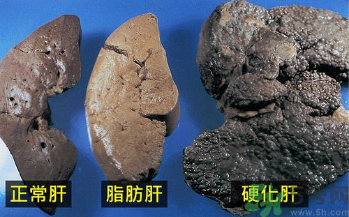 得了脂肪肝該怎么治？脂肪肝對人體危害有多大？