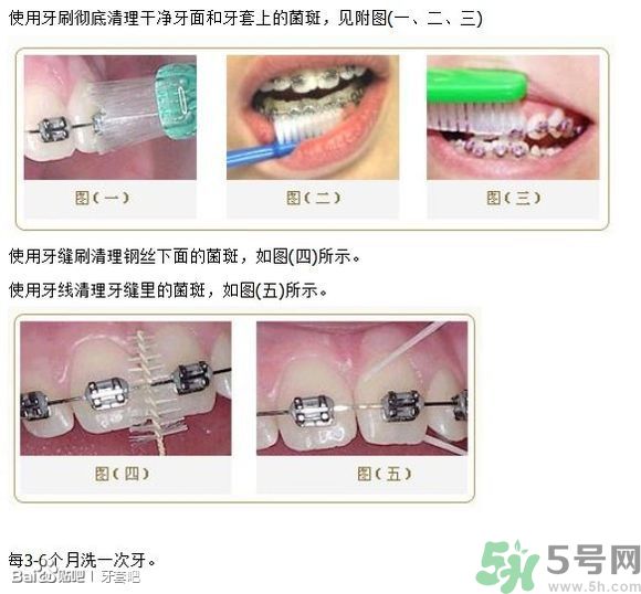 18歲還能戴牙套嗎？戴牙套真的能瘦臉改變臉型嗎？