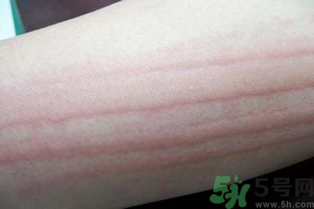蕁麻疹會不會傳染？蕁麻疹怎么治才能好？