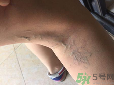 40歲女性小腿靜脈曲張?jiān)趺崔k？