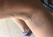 40歲女性小腿靜脈曲張怎么辦？