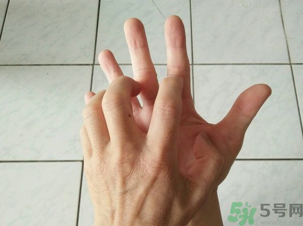 手上起水泡是什么原因？怎樣預(yù)防手上起水泡？