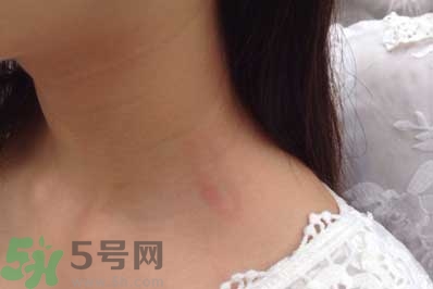 種草莓吻痕是什么意思？吻痕是怎么弄出來的？