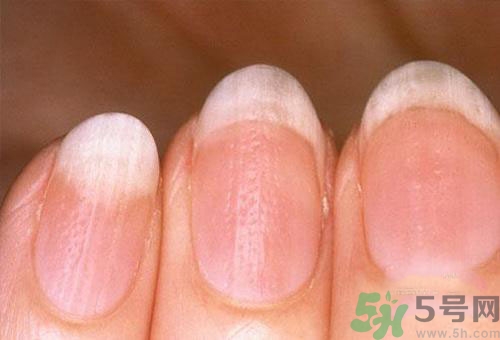 指甲發(fā)白是怎么回事？指甲發(fā)白代表什么？