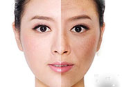 激光美白有用嗎？激光美白可以維持多久？