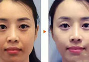 激光美白多少錢(qián)？激光美白價(jià)格
