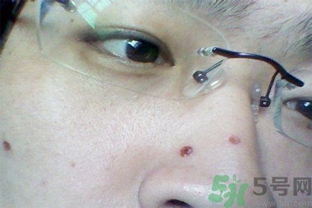 激光點痣后可以洗臉嗎？激光點痣后需要注意什么？