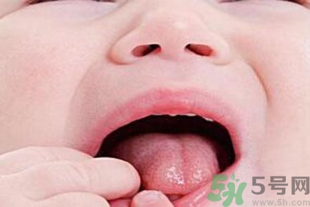 寶寶口腔潰瘍怎么辦？治療寶寶口腔潰瘍方法有什么？