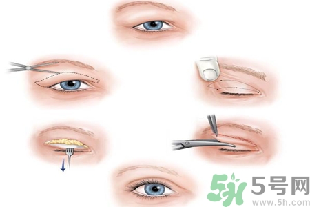 割雙眼皮分哪幾種？割雙眼皮需要多少錢？