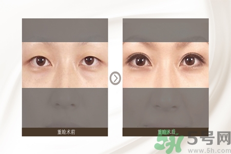 割雙眼皮分哪幾種？割雙眼皮需要多少錢？