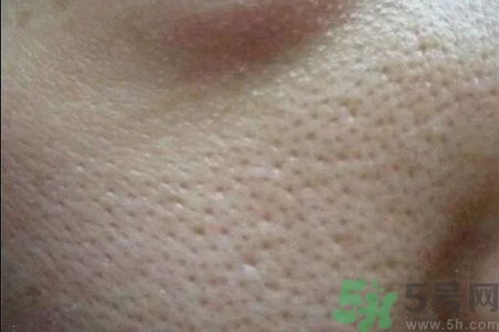 皮膚毛孔粗大原因有哪些？如何預(yù)防皮膚毛孔粗大？