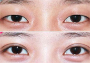 割雙眼皮分哪幾種？割雙眼皮需要多少錢？