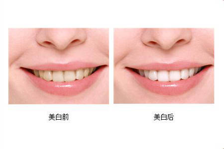 冷光美白牙齒可以保持多長時(shí)間？冷光美白牙齒有副作用嗎？