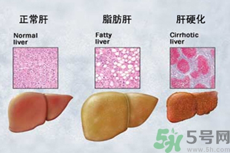 妊娠急性脂肪肝是什么？妊娠急性脂肪肝的治療方法？