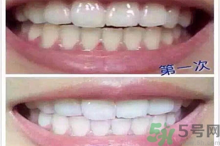 冷光美白牙齒的價(jià)格是多少？做冷光美白牙齒需要多少錢(qián)？