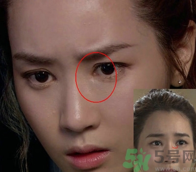 開(kāi)眼角多少錢(qián)？開(kāi)眼角有什么危害？
