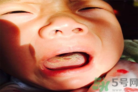 舌頭燙傷后該怎么辦呢？舌頭燙傷后應該注意吃什么？?