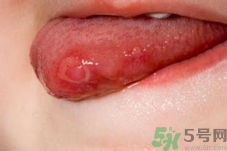 舌頭長(zhǎng)泡怎么辦？舌頭長(zhǎng)泡的原因？