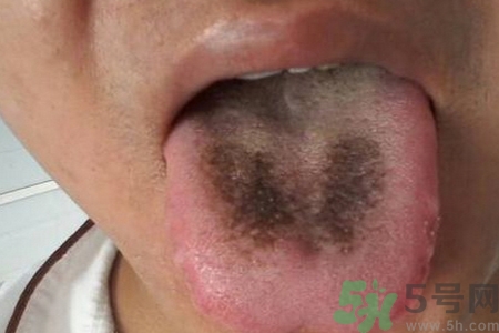 舌頭發(fā)黑怎么回事？舌頭發(fā)黑怎么辦？