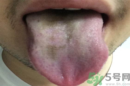 舌頭發(fā)黑怎么回事？舌頭發(fā)黑怎么辦？