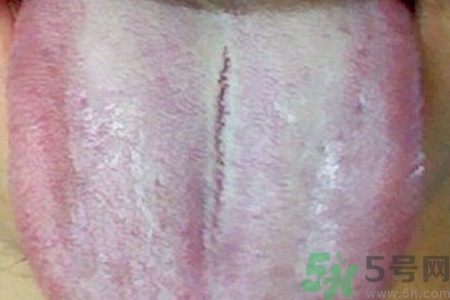 舌頭發(fā)白是什么原因？舌苔發(fā)白是怎么辦？