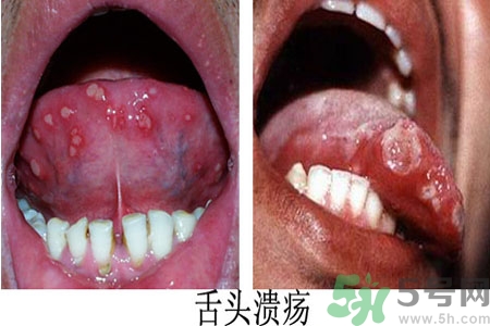 舌頭潰瘍?cè)趺崔k？舌頭潰瘍的原因？