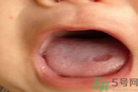 舌頭潰瘍怎么辦？舌頭潰瘍的原因？