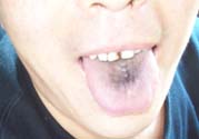 舌頭發(fā)黑怎么回事？舌頭發(fā)黑怎么辦？