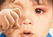 寶寶得了紅眼病怎么辦？寶寶得了紅眼病怎么治？