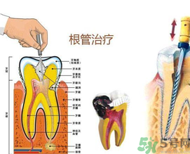 什么是根管治療？為什么牙齒疼要做根管治療？