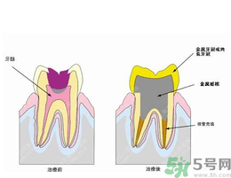 什么是根管治療？為什么牙齒疼要做根管治療？