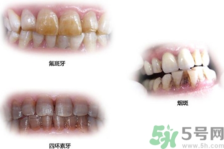 四環(huán)素牙是什么？四環(huán)素牙是怎么形成的？
