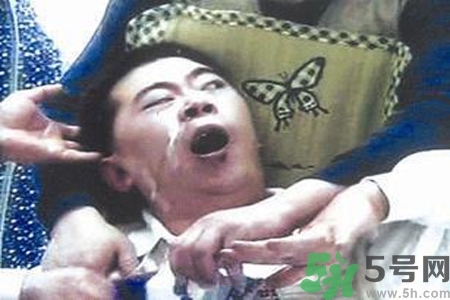 癲癇的典型癥狀有哪些？癲癇是什么？