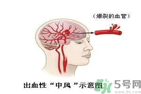 腦中風(fēng)的護(hù)理措施？腦中風(fēng)的飲食護(hù)理？