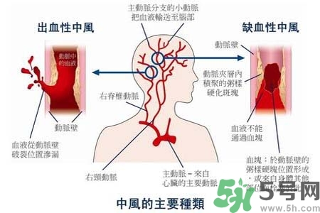 腦中風(fēng)的發(fā)病因素？腦中風(fēng)的并發(fā)癥有哪些 ？