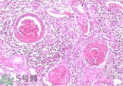 慢性腎炎能治好嗎？慢性腎炎能活多久？