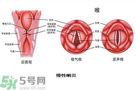 慢性咽炎是什么？慢性咽炎的癥狀有哪些？