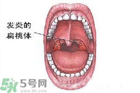 慢性咽炎是什么？慢性咽炎的癥狀有哪些？