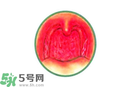 慢性咽炎的治療方法？慢性咽炎的藥物治療？