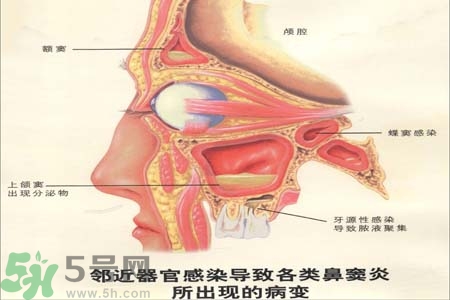 鼻竇炎是什么？鼻竇炎的癥狀有哪些？
