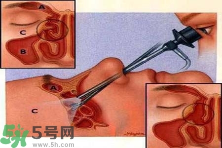 鼻竇炎的高發(fā)人群？如何預防鼻竇炎？