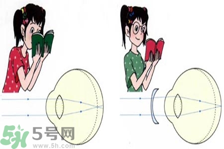 近視眼的發(fā)病因素？近視眼的并發(fā)癥有哪些？