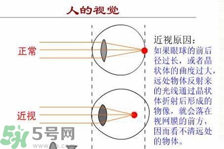 近視眼高發(fā)人群？如何預(yù)防近視眼？