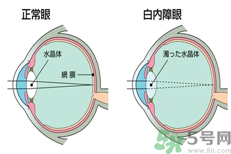 白內(nèi)障的發(fā)病因素是什么？白內(nèi)障并發(fā)癥有哪些？