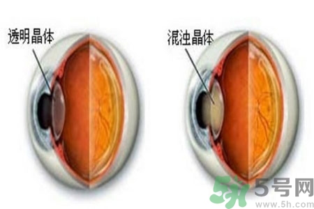 白內(nèi)障治療方法是什么？白內(nèi)障可以用什么藥物治療？