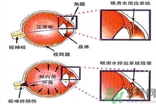 青光眼的發(fā)病因素是什么？青光眼的并發(fā)癥有哪些？