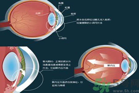 青光眼的高發(fā)人群有哪些？如何預防青光眼？