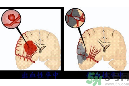 腦出血的發(fā)病因素是什么？腦出血的并發(fā)癥有哪些？